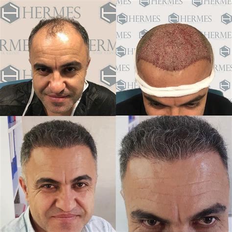 hermes hair clinic